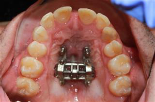 Maxillary Skeletal Expansion