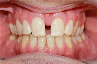 Maxillary Skeletal Expansion